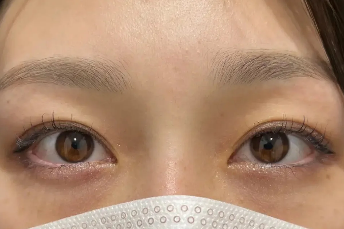 二重埋没法のダウンタイム、実際どうだった？“バレずに変われる”って本当？【HAABクリニック 田中統括院長監修】