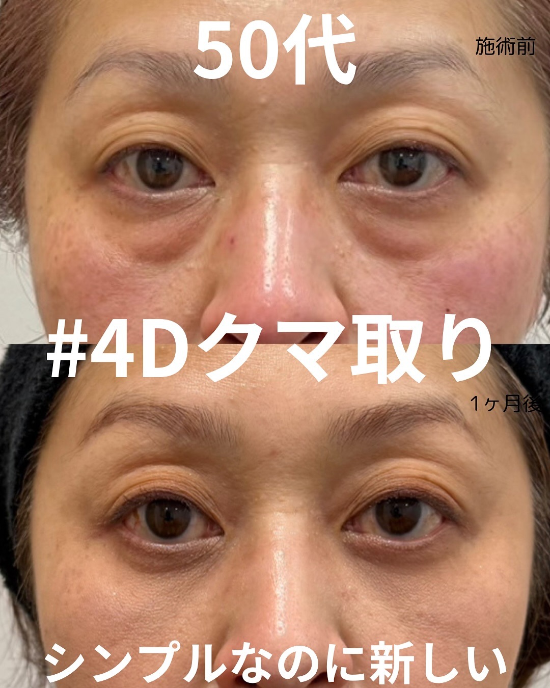 目の下の脂肪取りで顔の印象を変える！アエルクリニックの提案する4Dクマ取り®という選択肢