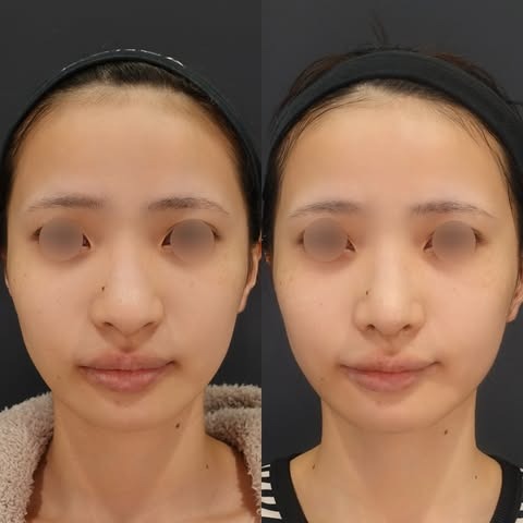 鼻先が丸くてコンプレックス…“ちょっと整えるだけ”でここまで変わる自然な印象｜東京・渋谷区LIVIN CLINIC監修