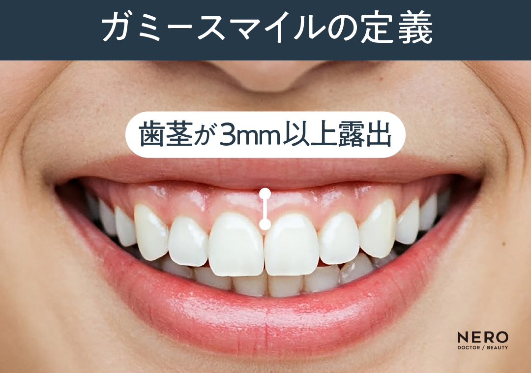 ガミースマイル　ガミースマイル治療―ボトックスから外科施術までの基礎と最新アプローチ｜NERO DOCTOR / BEAUTY（美容医療）