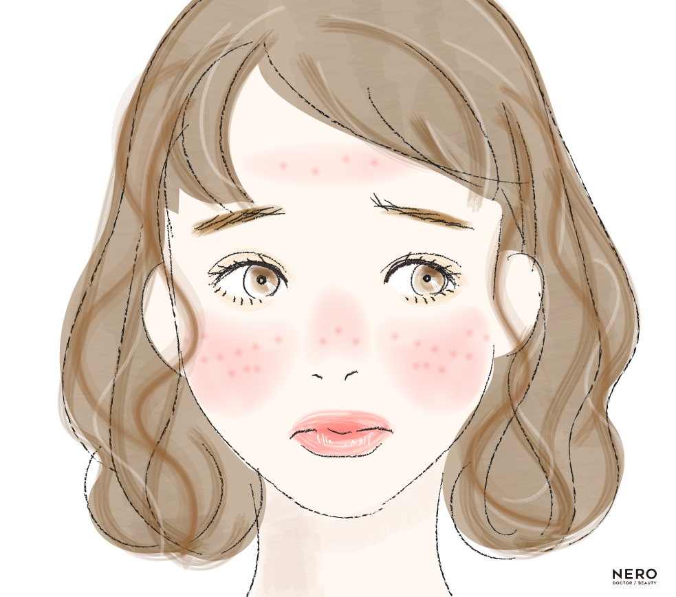 赤ら顔　赤ら顔・酒さは“敏感肌”とは別モノ？見逃されがちな疾患系の赤みに注意！｜NERO DOCTOR / BEAUTY（美容医療）