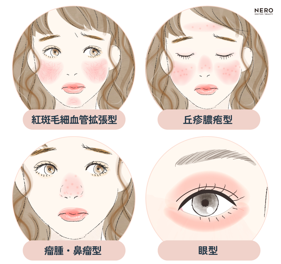酒さ分類　赤ら顔・酒さは“敏感肌”とは別モノ？見逃されがちな疾患系の赤みに注意！｜NERO DOCTOR / BEAUTY（美容医療）