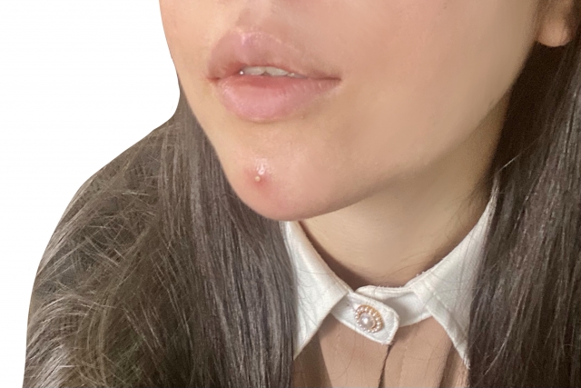 顎にニキビができた女性　ニキビにレーザー治療は効果ある？機器の特徴やクリニック選びのポイントも｜NERO DOCTOR / BEAUTY（美容医療）