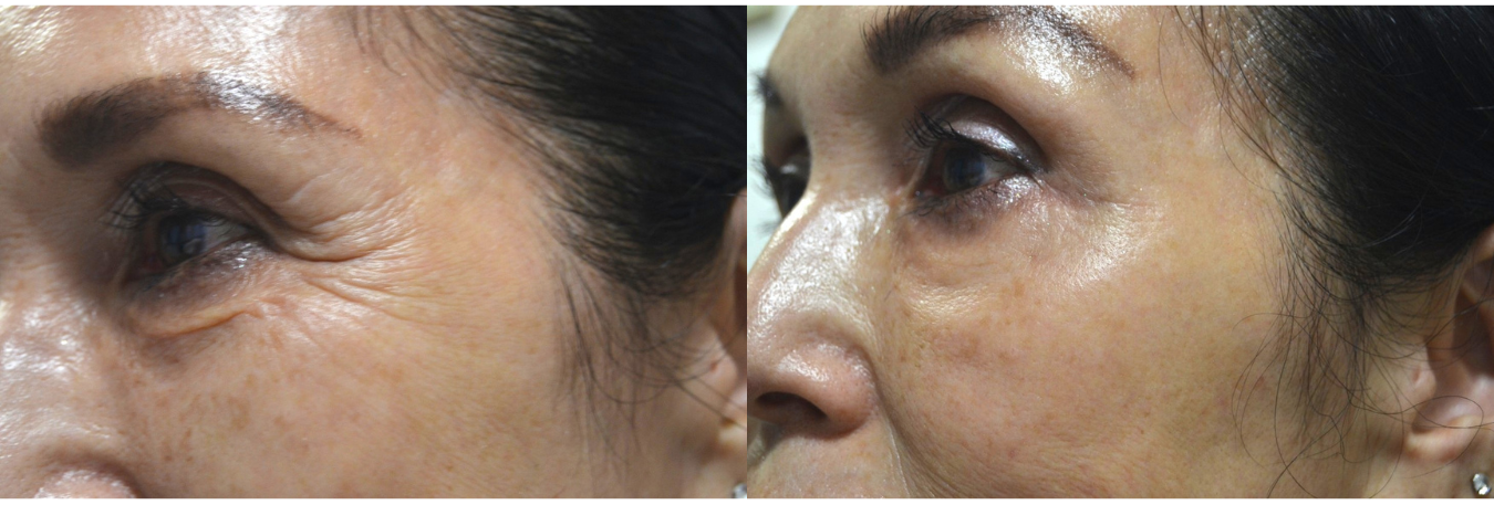 ヒト胎盤由来コラーゲン「ベビーコラーゲン」が選ばれる理由｜自然なハリとツヤを叶える新世代コラーゲン注入