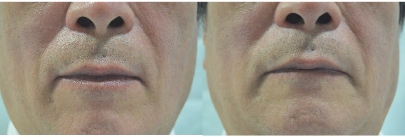 ヒト胎盤由来コラーゲン「ベビーコラーゲン」が選ばれる理由｜自然なハリとツヤを叶える新世代コラーゲン注入