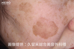 シミ取りの成功は正しい診断が鍵！福岡・久留米総合美容外科（美容外科・形成外科・皮膚科）監修