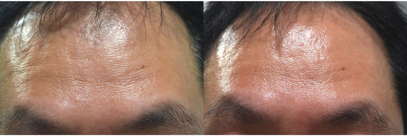 ヒト胎盤由来コラーゲン「ベビーコラーゲン」が選ばれる理由｜自然なハリとツヤを叶える新世代コラーゲン注入