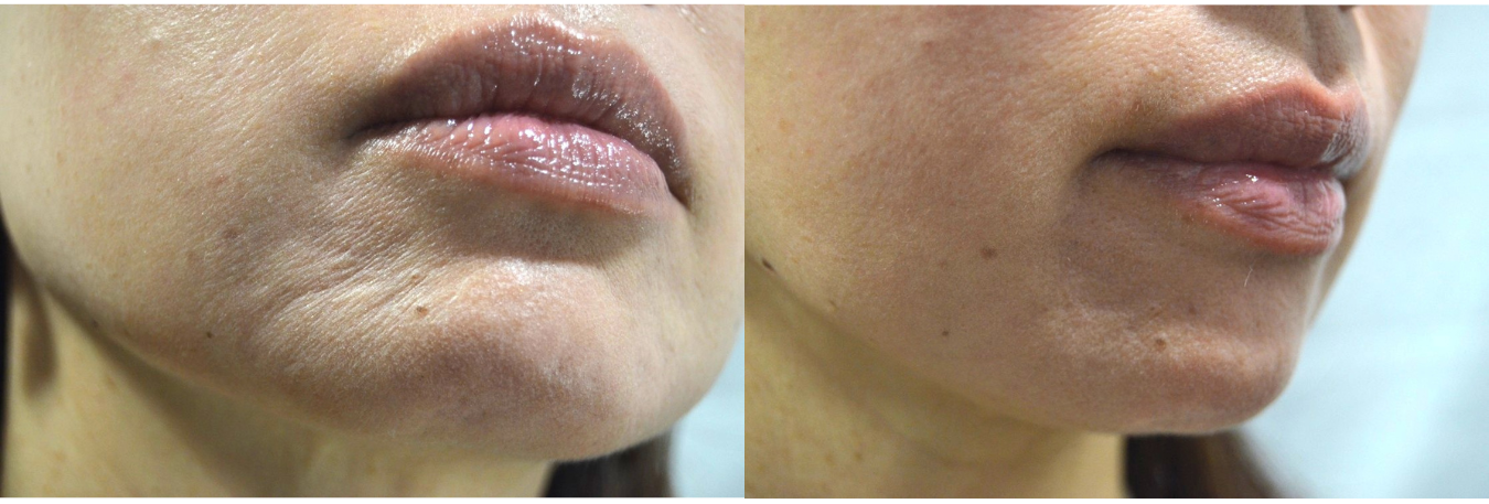 ヒト胎盤由来コラーゲン「ベビーコラーゲン」が選ばれる理由｜自然なハリとツヤを叶える新世代コラーゲン注入