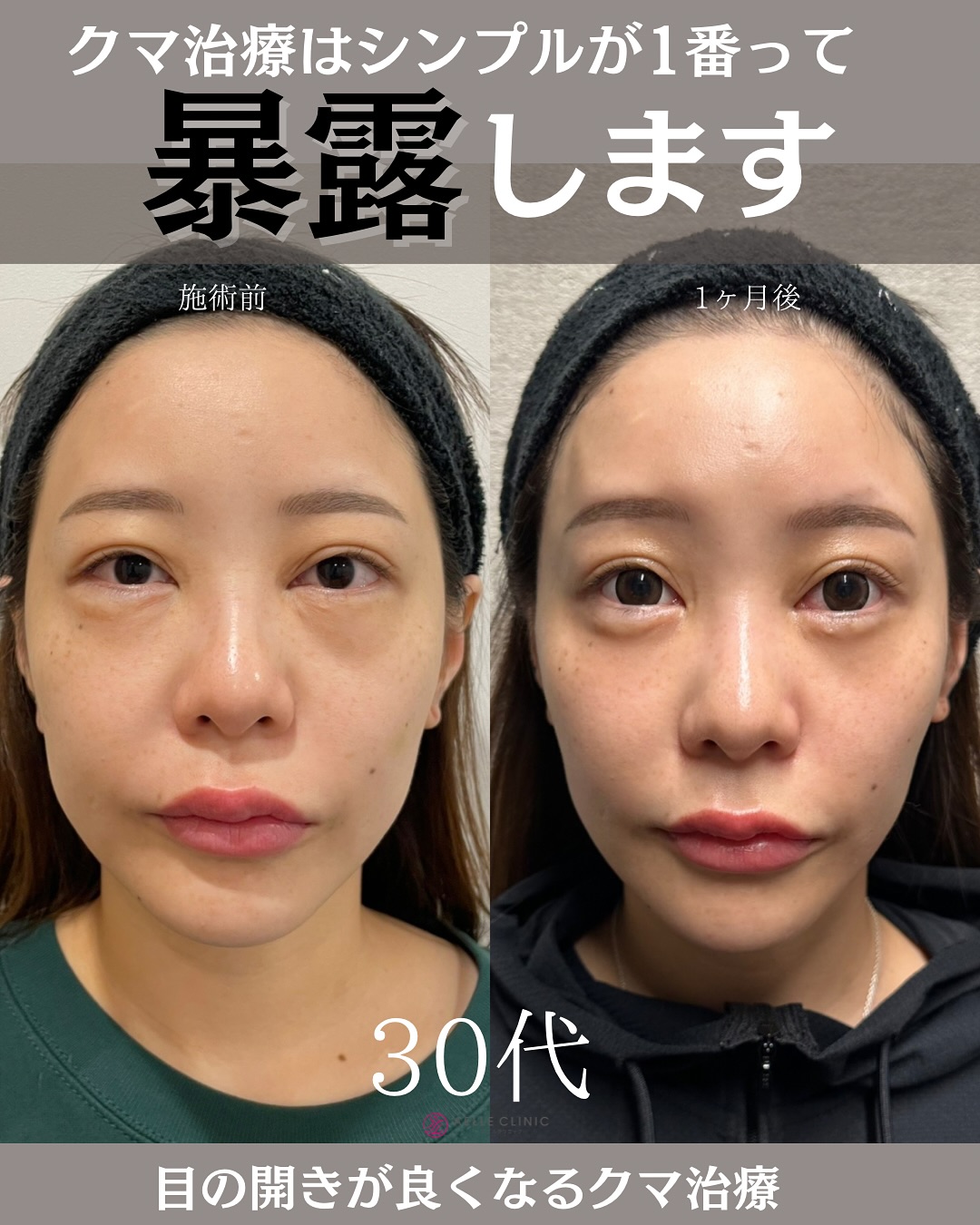 クマ取りのおすすめは?経結膜脱脂術で痛み・腫れを抑えるアエルクリニックのこだわりとは