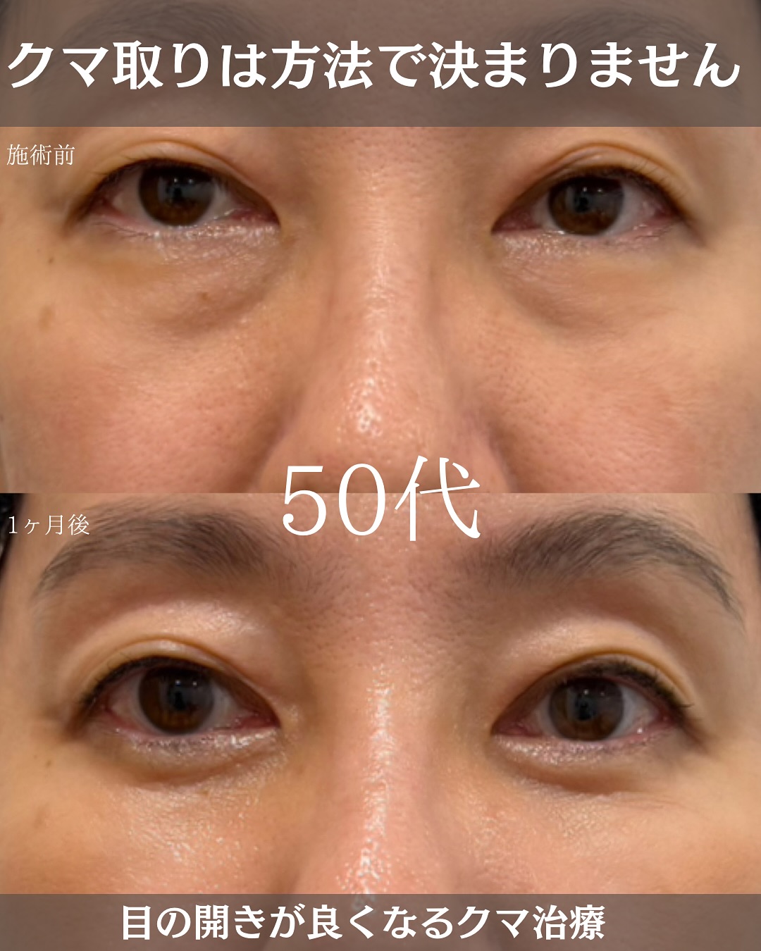 クマ取りのおすすめは?経結膜脱脂術で痛み・腫れを抑えるアエルクリニックのこだわりとは