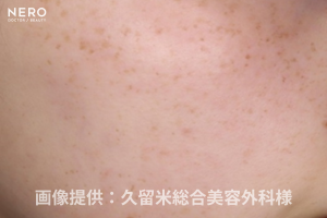 シミ取りの成功は正しい診断が鍵！福岡・久留米総合美容外科（美容外科・形成外科・皮膚科）監修