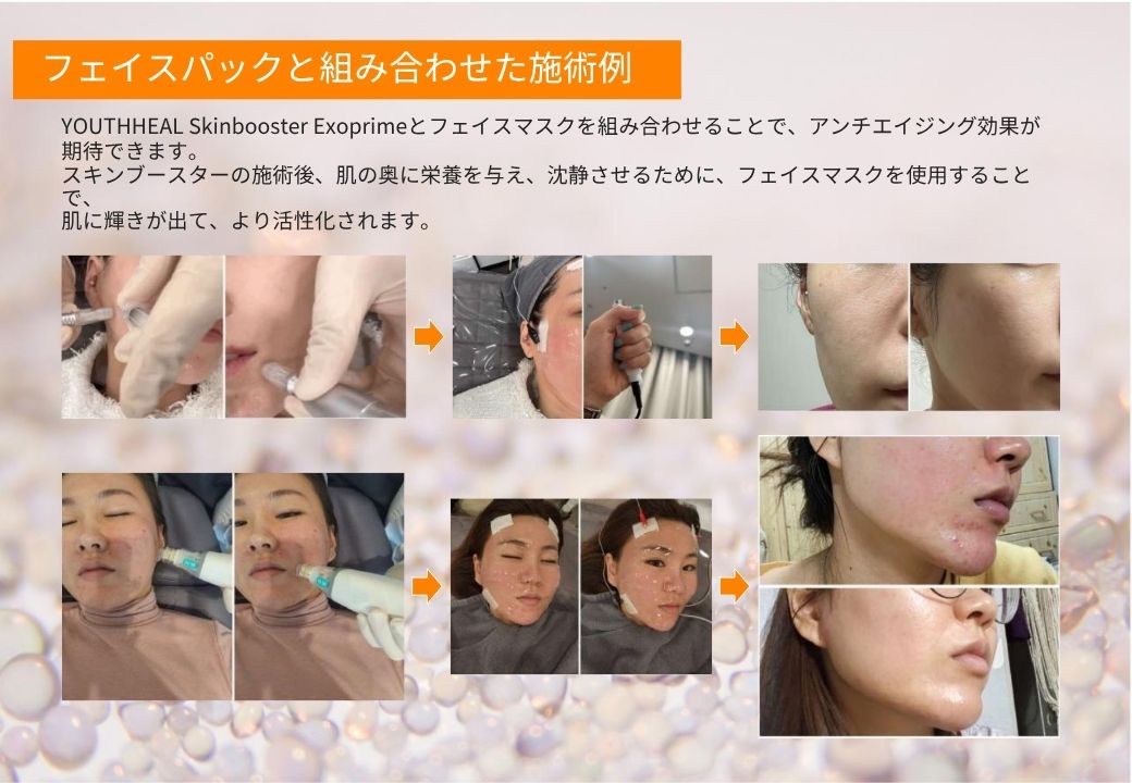 ユースヒール（キャビア注射）で目覚めるハリとツヤ！全方位のスキンケアが叶う？！大注目の注入をKOLが解説