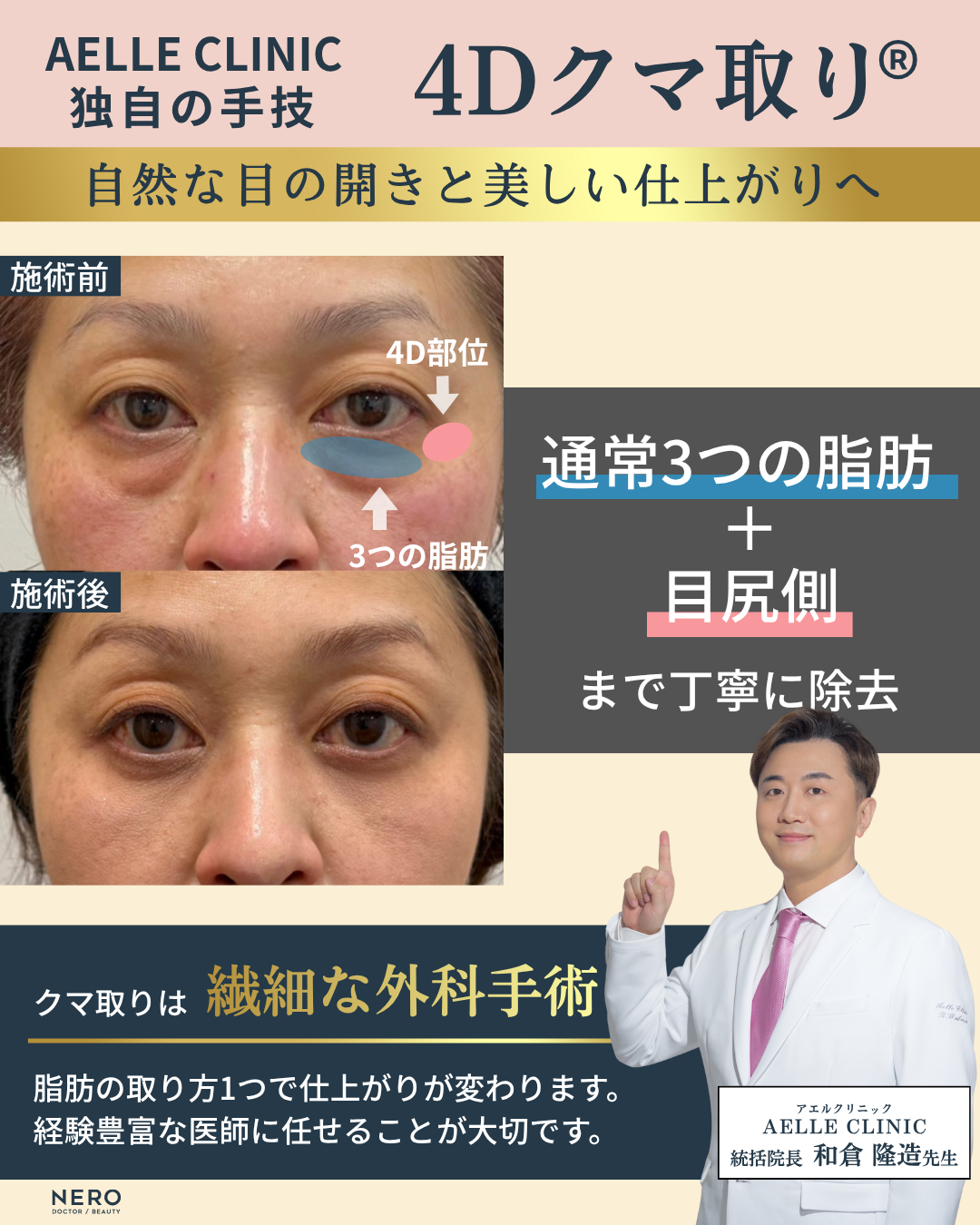 クマ取りのおすすめは?経結膜脱脂術で痛み・腫れを抑えるアエルクリニックのこだわりとは