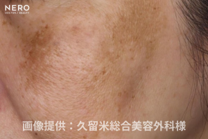 シミ取りの成功は正しい診断が鍵！福岡・久留米総合美容外科（美容外科・形成外科・皮膚科）監修