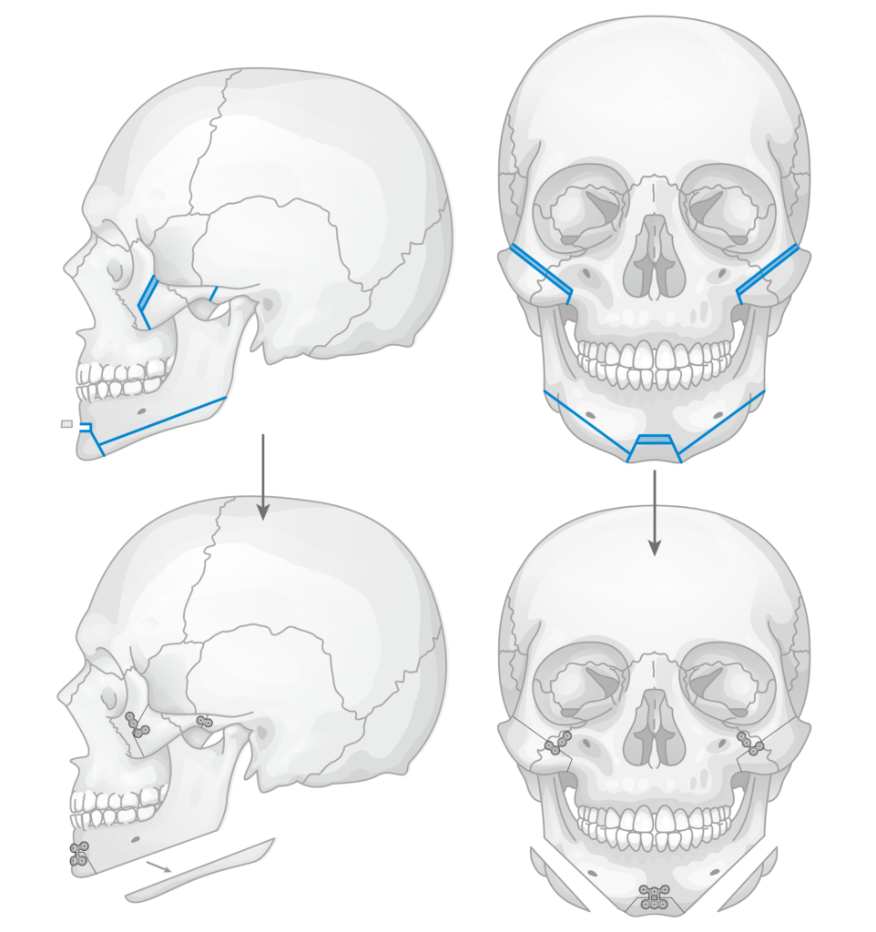 骨切り・脂肪吸引など「輪郭形成で骨格はどこまで変えられる?」名医のSNSは「チャンピオン症例だらけ!?」と驚くかも。“衝撃ビフォーアフター”をチェック|NERO DOCTOR / BEAUTY(美容医療)