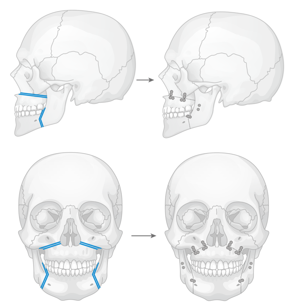 骨切り・脂肪吸引など「輪郭形成で骨格はどこまで変えられる?」名医のSNSは「チャンピオン症例だらけ!?」と驚くかも。“衝撃ビフォーアフター”をチェック|NERO DOCTOR / BEAUTY(美容医療)