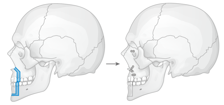 骨切り・脂肪吸引など「輪郭形成で骨格はどこまで変えられる?」名医のSNSは「チャンピオン症例だらけ!?」と驚くかも。“衝撃ビフォーアフター”をチェック|NERO DOCTOR / BEAUTY(美容医療)