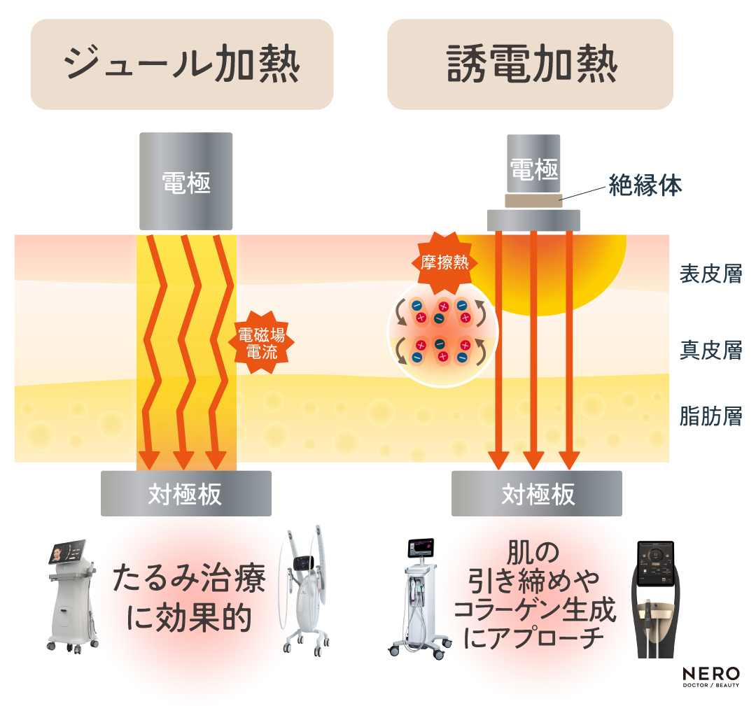 ジュール加熱　誘電加熱　2025年RF戦国時代！MHz、モノ・バイ、冷却機能から読み解く「賢いたるみ治療」の選び方｜NERO DOCTOR / BEAUTY（美容医療）