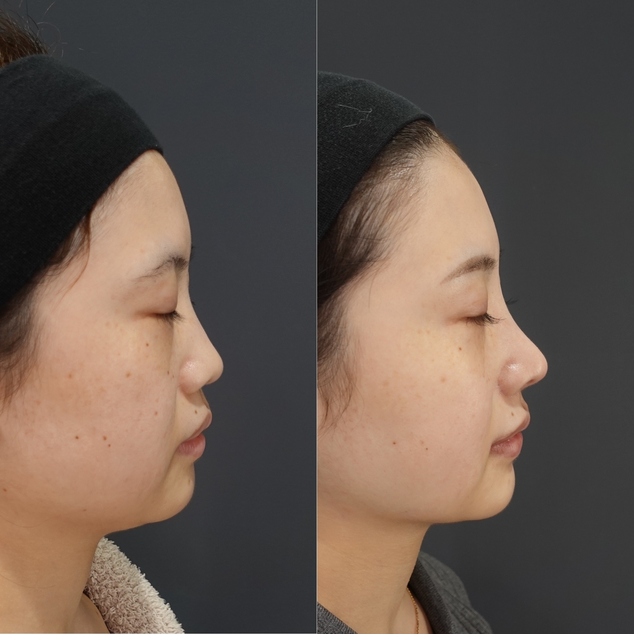 鼻筋のコンプレックス「のっぺり見える」を解消する、高さより大切な立体感を鼻整形のプロLIVIN CLINIC新行内院長に聞く