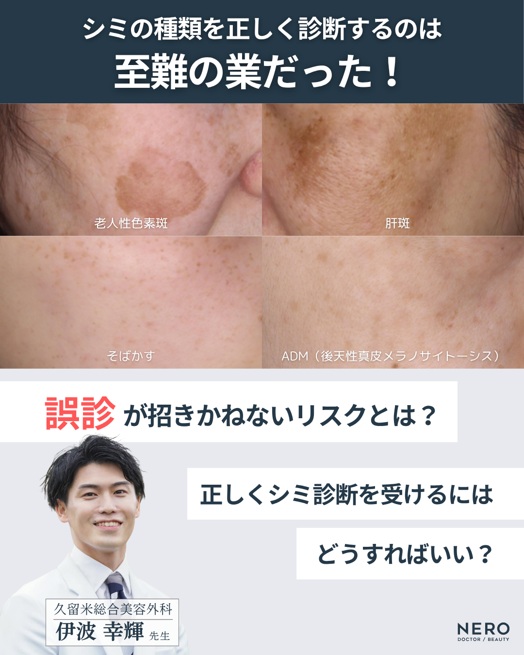 シミ取りの成功は正しい診断が鍵！福岡・久留米総合美容外科（美容外科・形成外科・皮膚科）監修