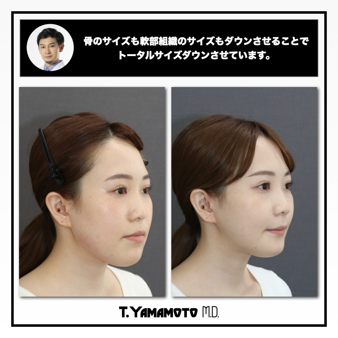 骨切り・脂肪吸引など「輪郭形成で骨格はどこまで変えられる?」名医のSNSは「チャンピオン症例だらけ!?」と驚くかも。“衝撃ビフォーアフター”をチェック|NERO DOCTOR / BEAUTY(美容医療)