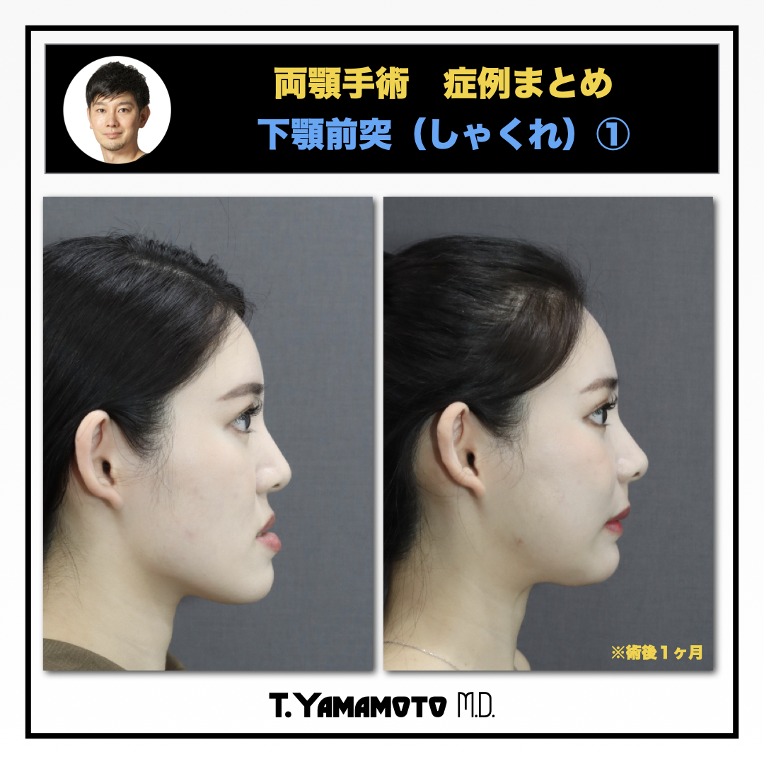 骨切り・脂肪吸引など「輪郭形成で骨格はどこまで変えられる?」名医のSNSは「チャンピオン症例だらけ!?」と驚くかも。“衝撃ビフォーアフター”をチェック|NERO DOCTOR / BEAUTY(美容医療)