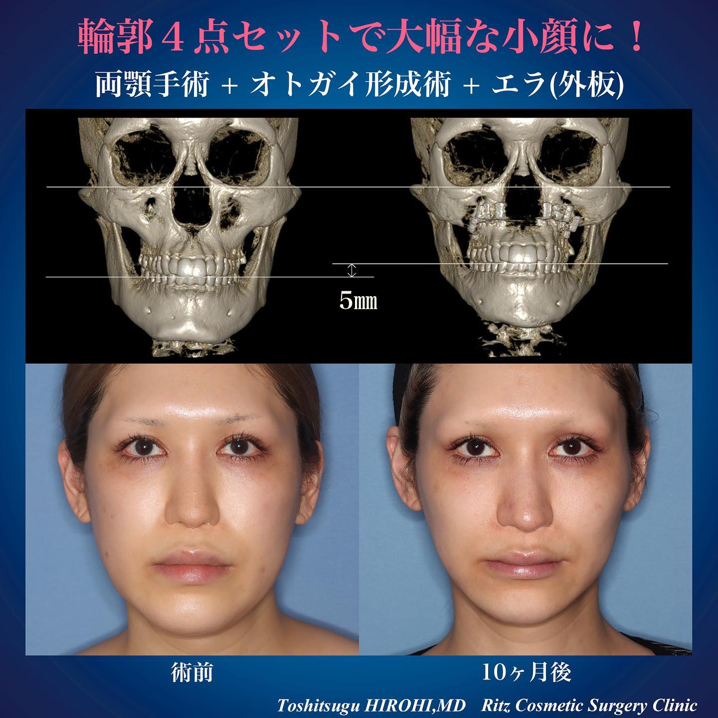 骨切り・脂肪吸引など「輪郭形成で骨格はどこまで変えられる?」名医のSNSは「チャンピオン症例だらけ!?」と驚くかも。“衝撃ビフォーアフター”をチェック|NERO DOCTOR / BEAUTY(美容医療)