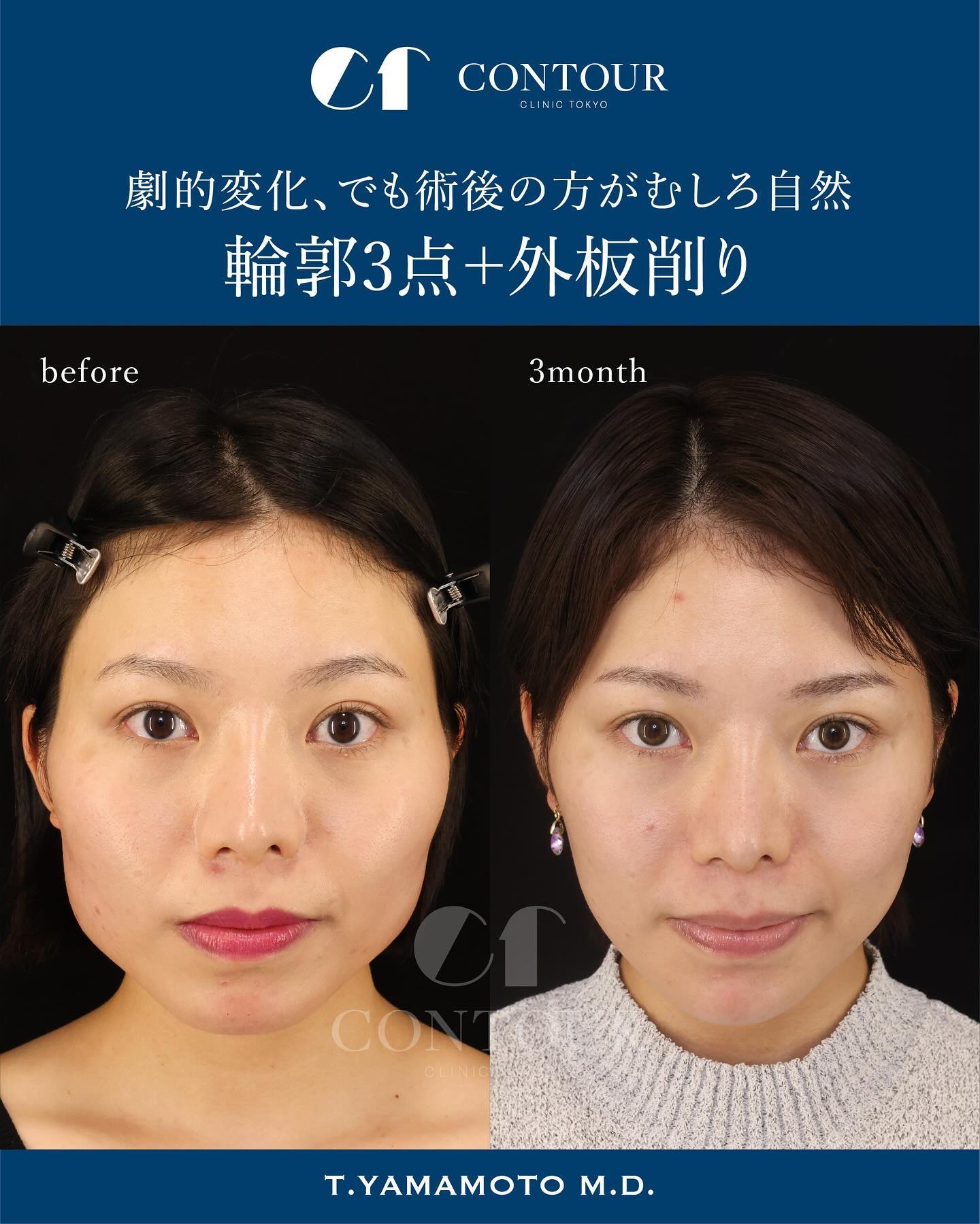 骨切り・脂肪吸引など「輪郭形成で骨格はどこまで変えられる?」名医のSNSは「チャンピオン症例だらけ!?」と驚くかも。“衝撃ビフォーアフター”をチェック|NERO DOCTOR / BEAUTY(美容医療)