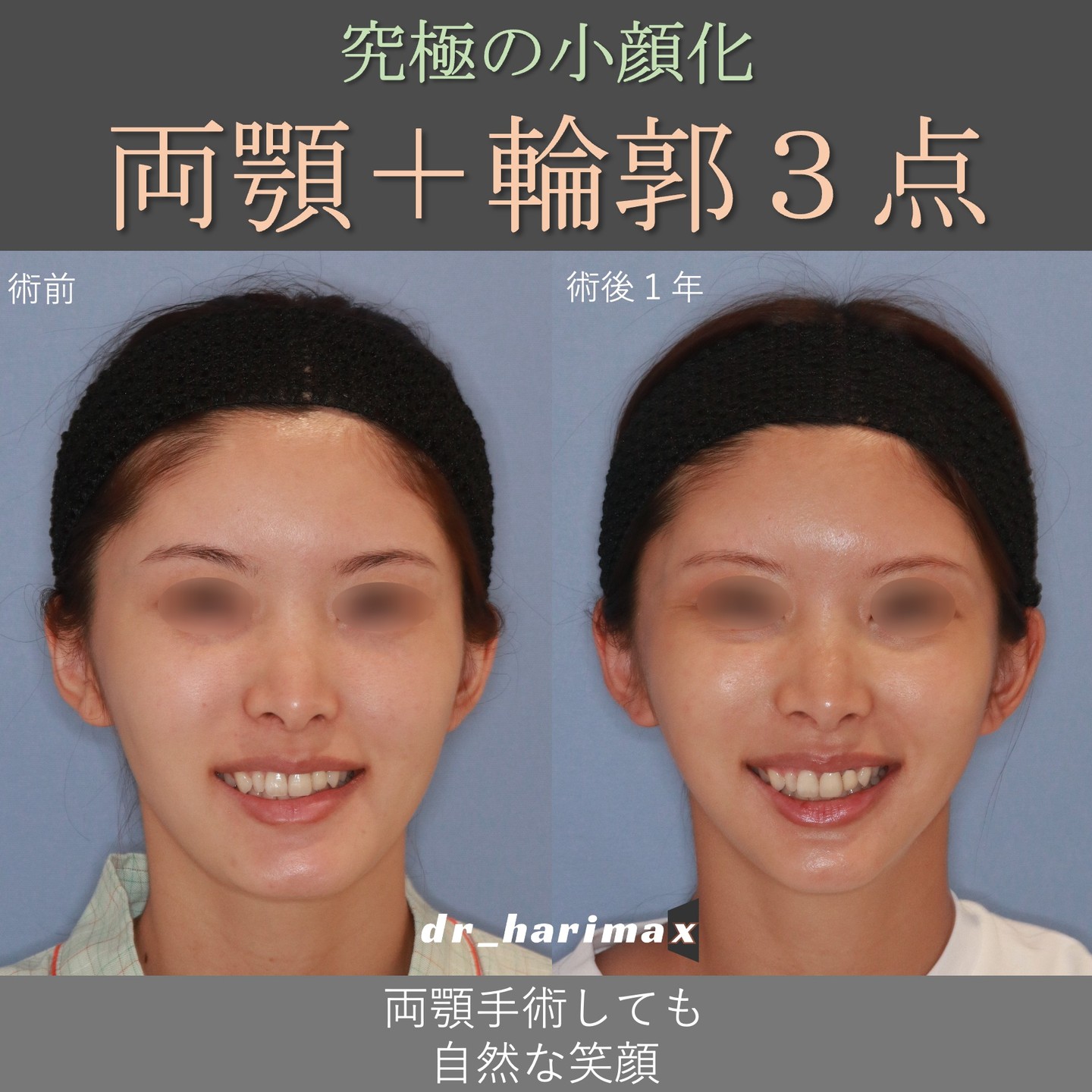 骨切り・脂肪吸引など「輪郭形成で骨格はどこまで変えられる?」名医のSNSは「チャンピオン症例だらけ!?」と驚くかも。“衝撃ビフォーアフター”をチェック|NERO DOCTOR / BEAUTY(美容医療)