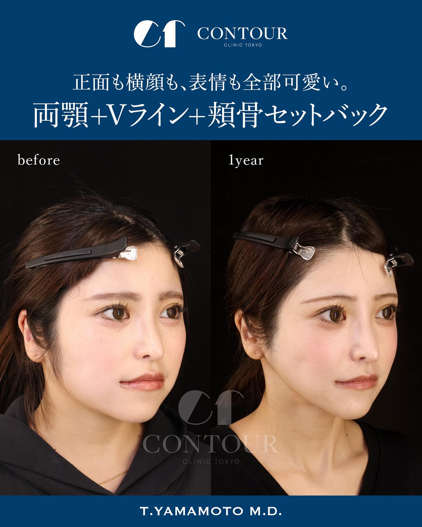 骨切り・脂肪吸引など「輪郭形成で骨格はどこまで変えられる?」名医のSNSは「チャンピオン症例だらけ!?」と驚くかも。“衝撃ビフォーアフター”をチェック|NERO DOCTOR / BEAUTY(美容医療)