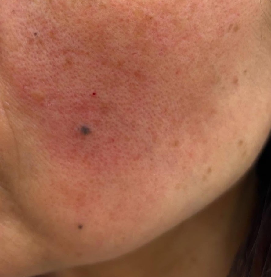 酒さは一生治らない？治療後も続く赤み…再発防止のカギは“正しい診断”！