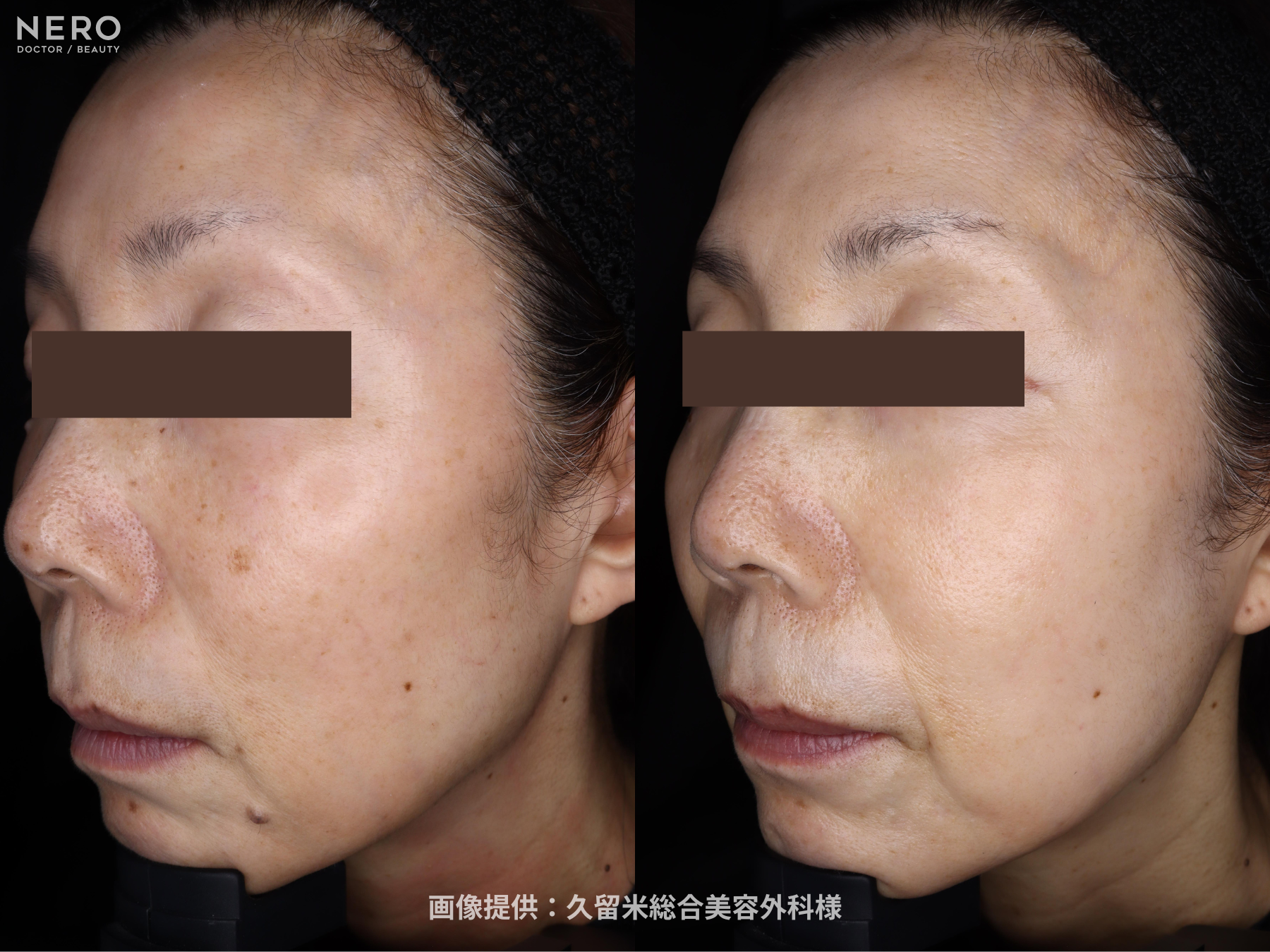 シミ取りの成功は正しい診断が鍵！福岡・久留米総合美容外科（美容外科・形成外科・美容皮膚科）監修