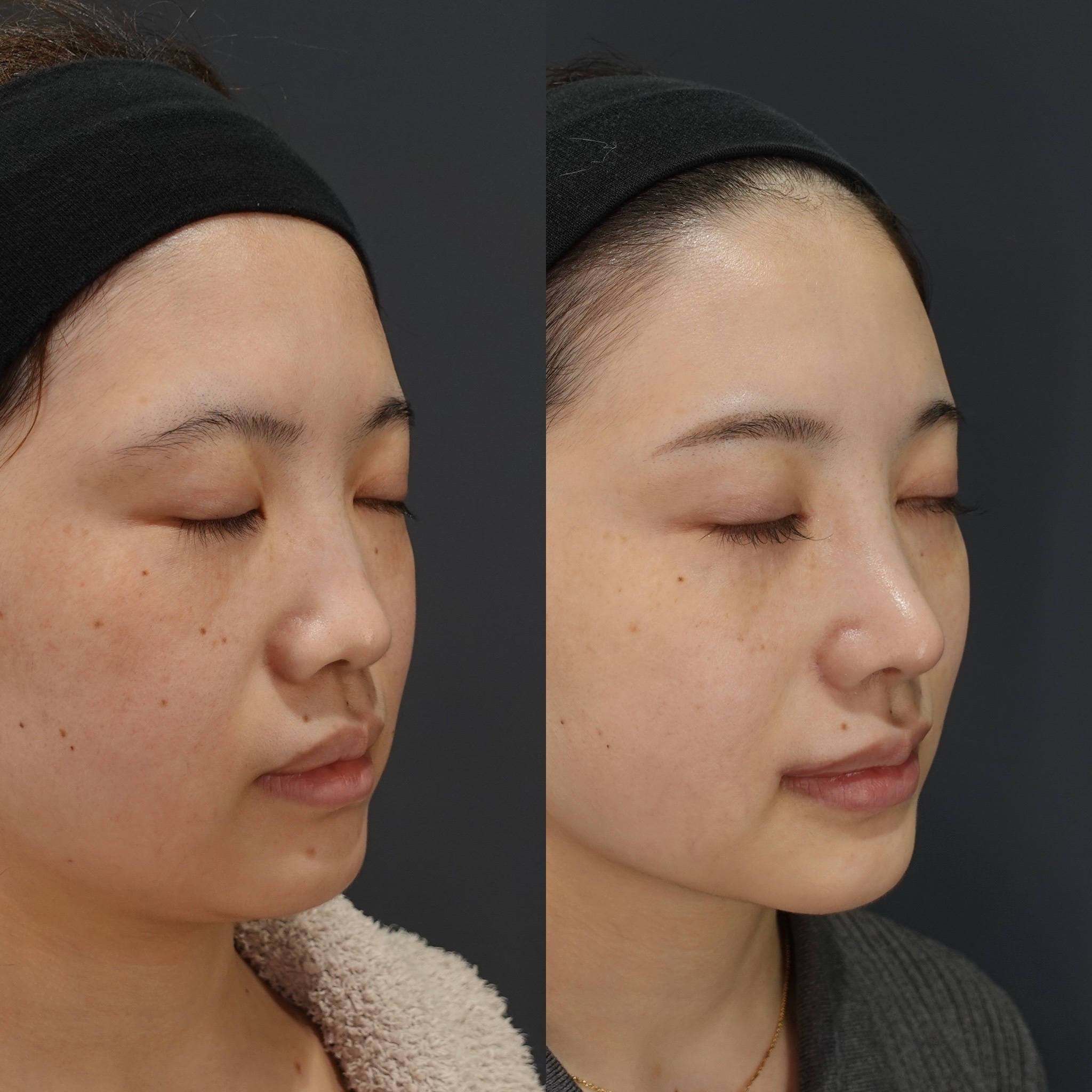 鼻筋のコンプレックス「のっぺり見える」を解消する、高さより大切な立体感を鼻整形のプロLIVIN CLINIC新行内院長に聞く