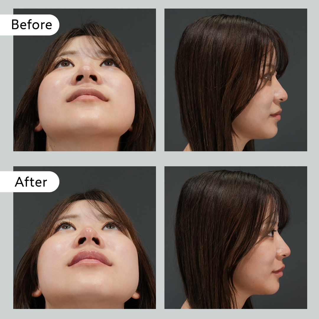 【BIANCA体験記事】本人の理想と医師の目線は違う？実際のカウンセリングと施術を徹底解剖！｜NERO DOCTOR / BEAUTY（美容医療）