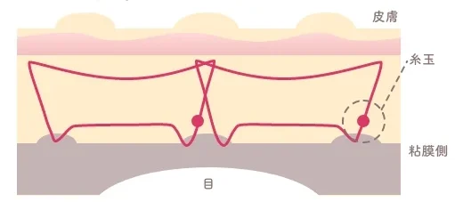 二重埋没法、取れるって本当?“取れにくさ”のカギと対策をプロが解説【HAABクリニック 田中統括院長監修】