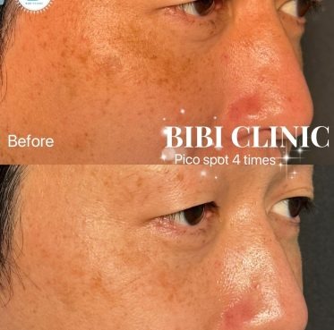 バンコクの美容クリニックでシミ取りを始めるなら－Bibi Clinicで紫外線に負けない素肌を目指す