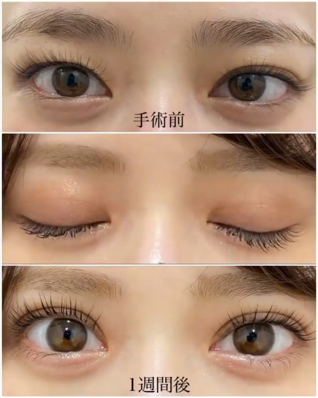 二重埋没法、取れるって本当?“取れにくさ”のカギと対策をプロが解説【HAABクリニック 田中統括院長監修】