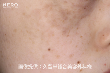 シミ取りの成功は正しい診断が鍵！福岡・久留米総合美容外科（美容外科・形成外科・皮膚科）監修