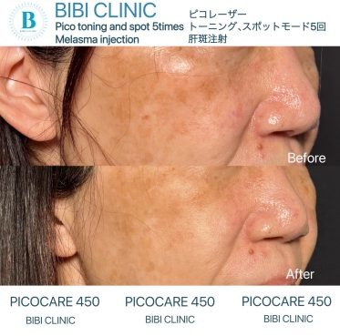 バンコクの美容クリニックでシミ取りを始めるなら－Bibi Clinicで紫外線に負けない素肌を目指す
