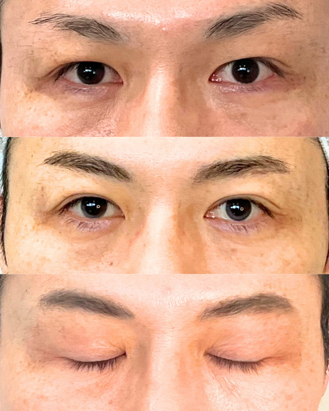 まぶたのたるみ取りに埋没法が選ばれる理由って?20代・40代の年代別“あえてナチュラル”な二重整形【オーキッド美容クリニック東京御徒町】