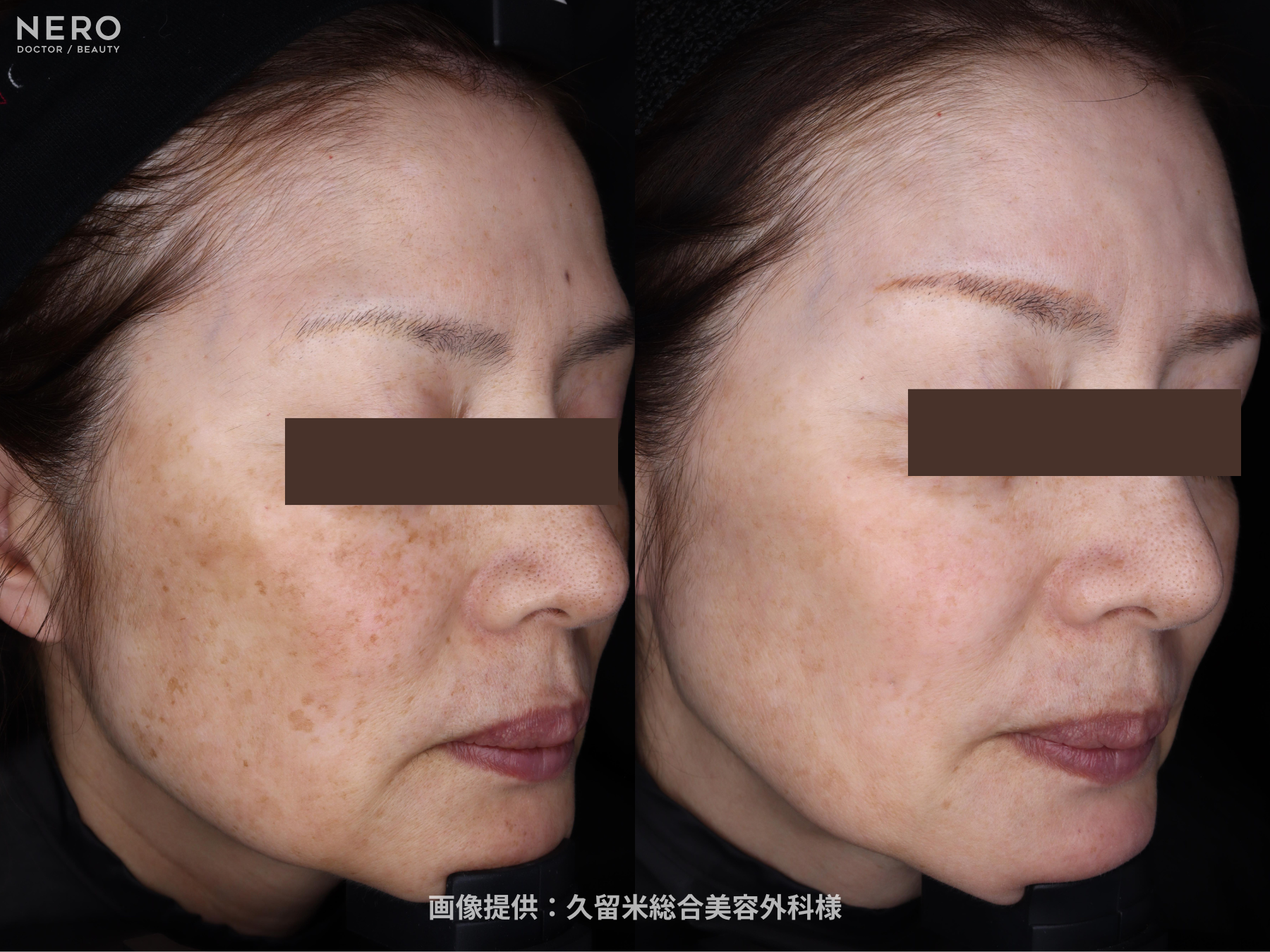 シミ取りの成功は正しい診断が鍵！福岡・久留米総合美容外科（美容外科・形成外科・美容皮膚科）監修