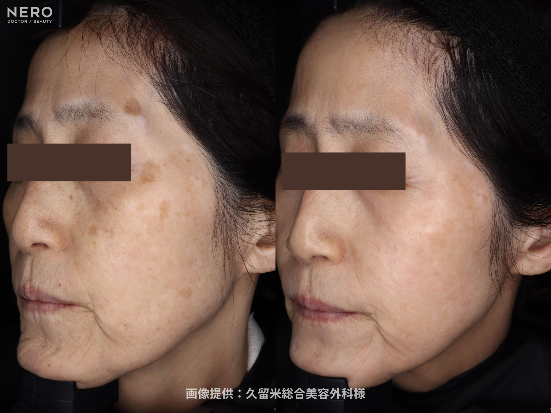 シミ取りの成功は正しい診断が鍵！福岡・久留米総合美容外科（美容外科・形成外科・美容皮膚科）監修