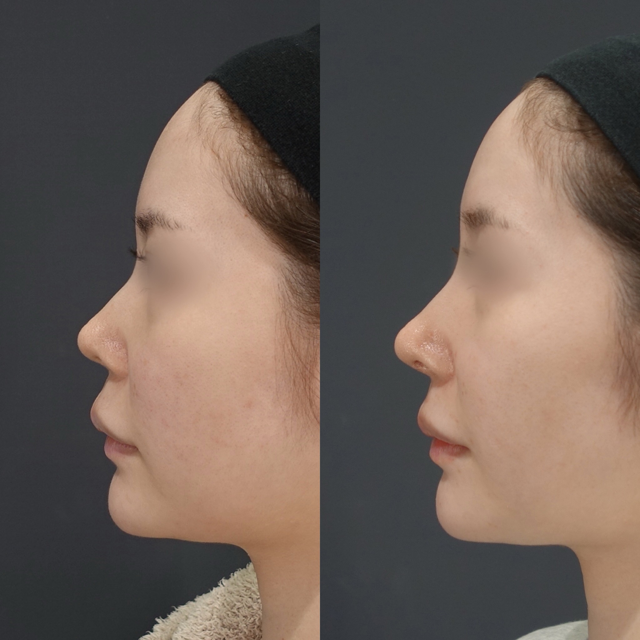 鼻筋のコンプレックス「のっぺり見える」を解消する、高さより大切な立体感を鼻整形のプロLIVIN CLINIC新行内院長に聞く