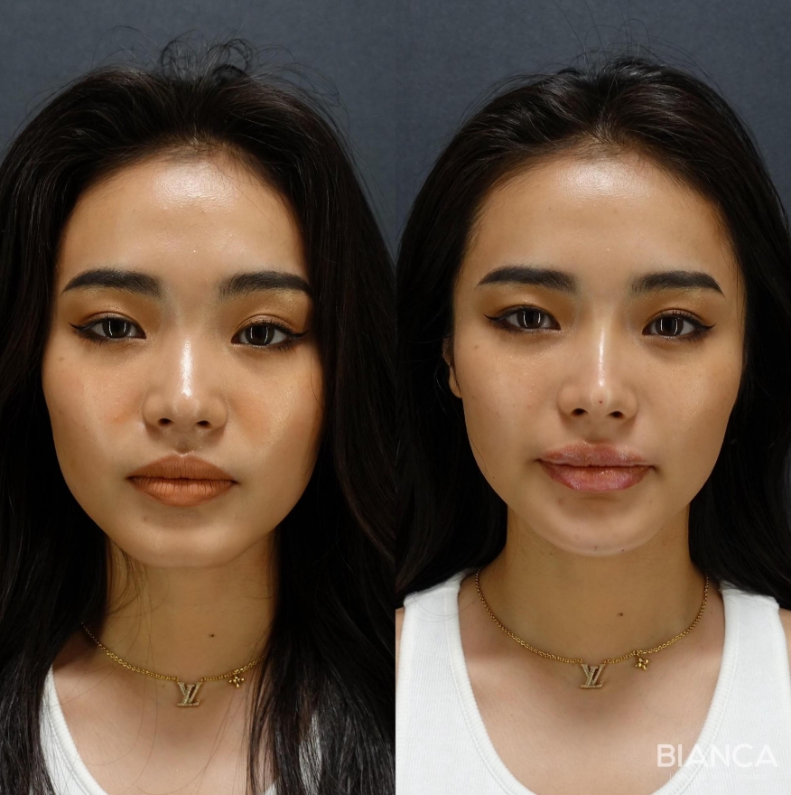 ビアンカクリニックに聞く美容医療のリアル!ヒアルロン酸注射に失明リスクがあるって本当?