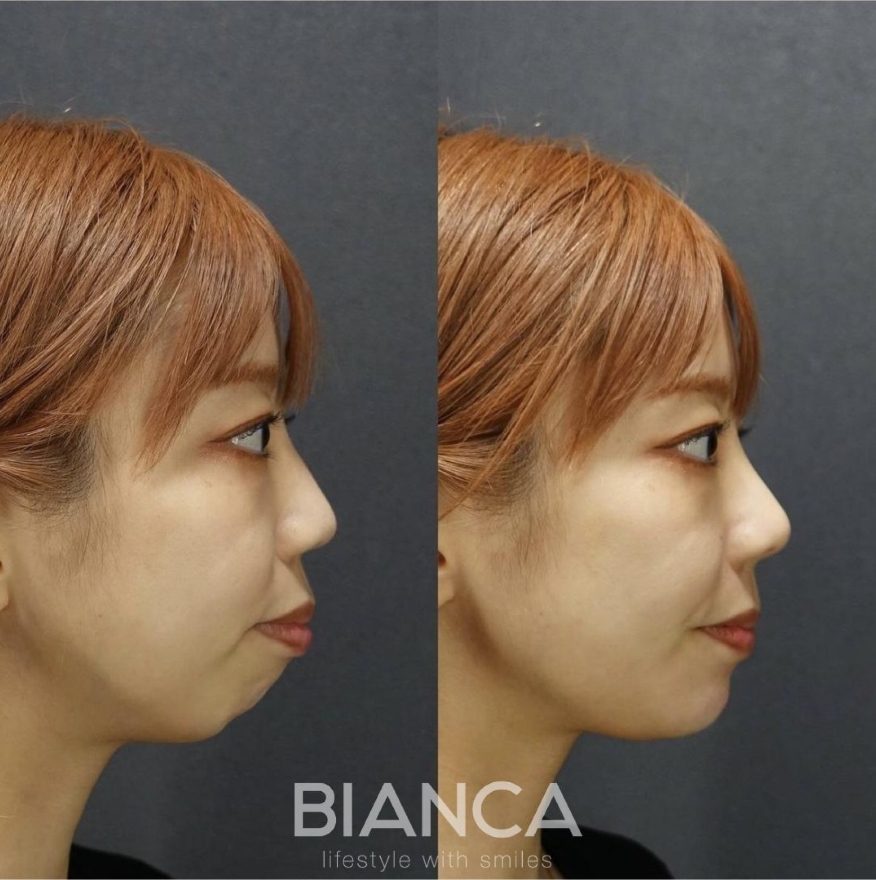 ビアンカクリニックに聞く美容医療のリアル!ヒアルロン酸注射に失明リスクがあるって本当?