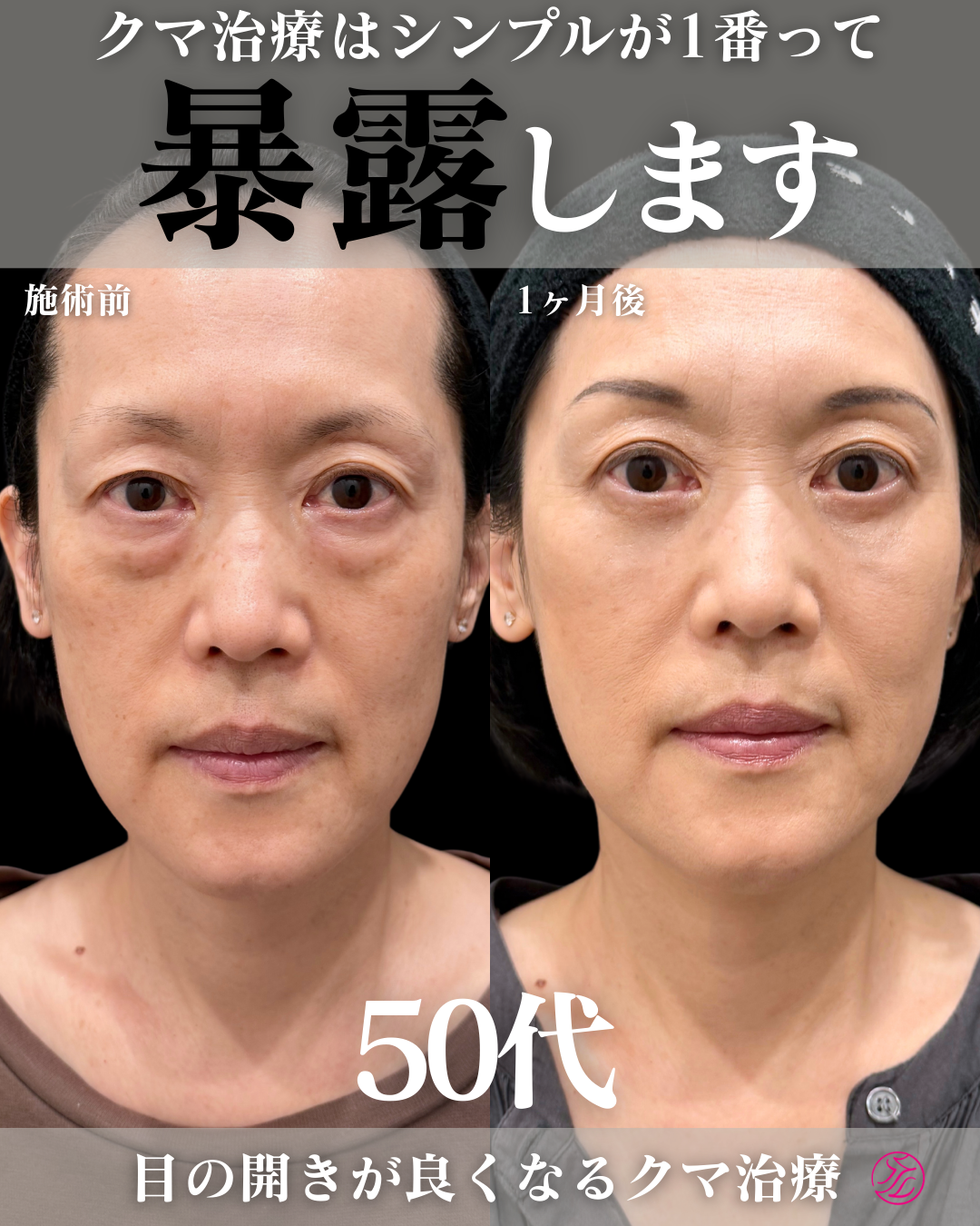 目の下の脂肪取りで失敗しないために。切らずに自然に整える、アエルクリニックの理想のクマ取り