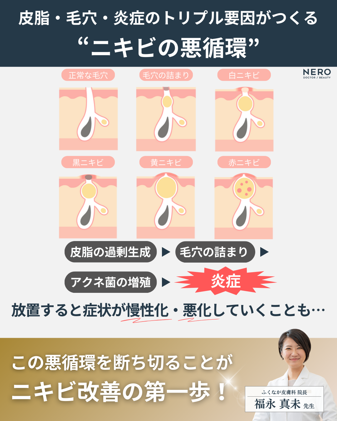 ニキビの治し方よりまず原因究明！滋賀・ふくなが皮膚科の原因から整える治療メソッドとは