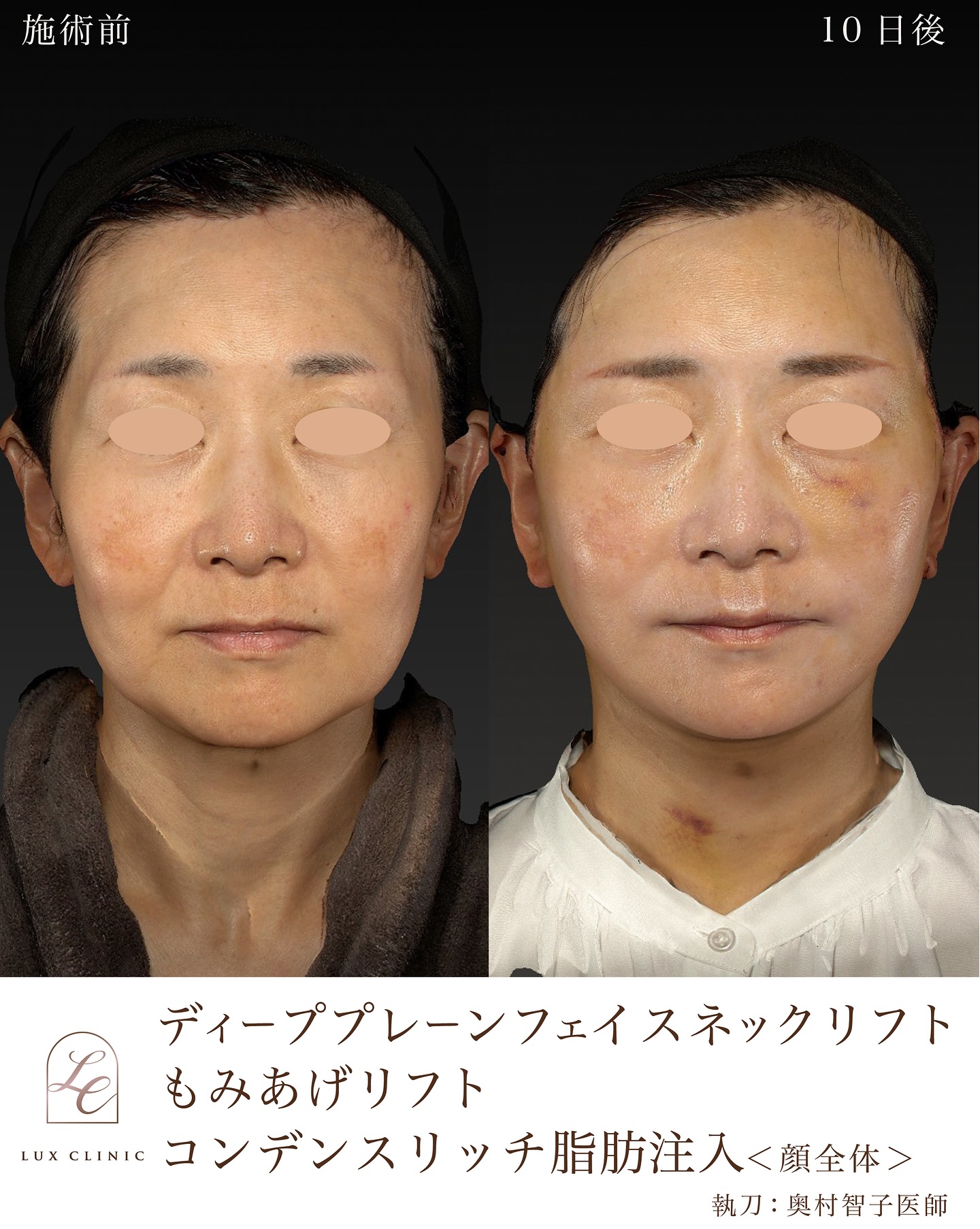 エイジングケアは何歳からでも遅くない！10年後を見据えた“顔の育て方”をリフトアップの名医が提案【東京・銀座 ルクスクリニック監修】