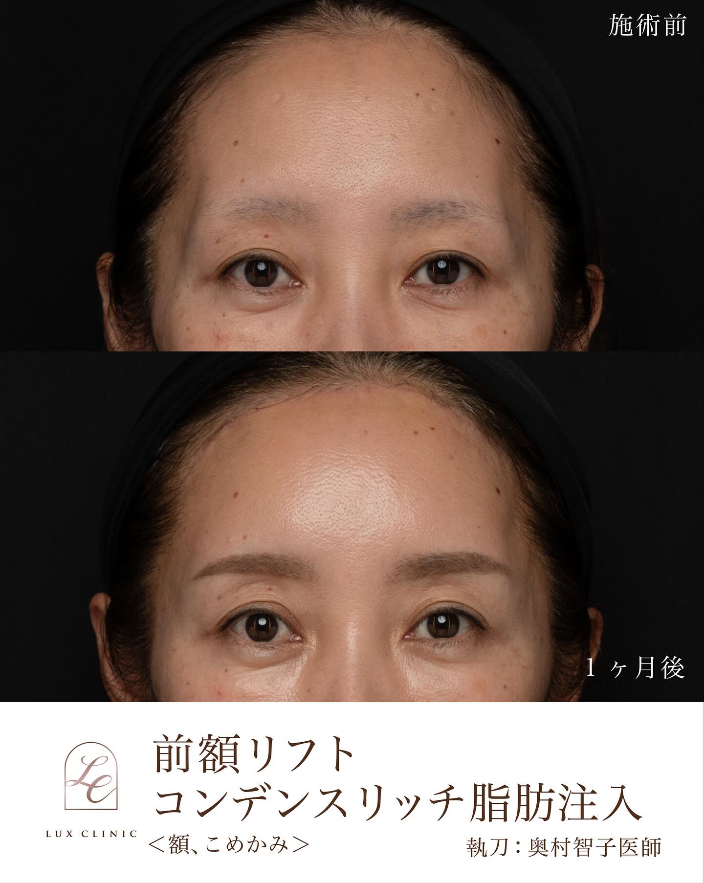 エイジングケアは何歳からでも遅くない！10年後を見据えた“顔の育て方”をリフトアップの名医が提案【東京・銀座 ルクスクリニック監修】