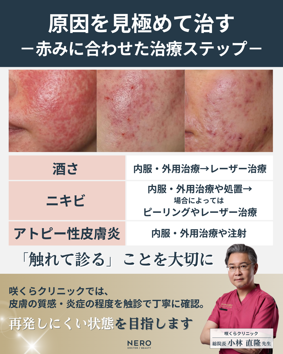 顔の赤みの原因を見極めて治す!酒さ・ニキビ・アトピー…症状別治療法まとめ